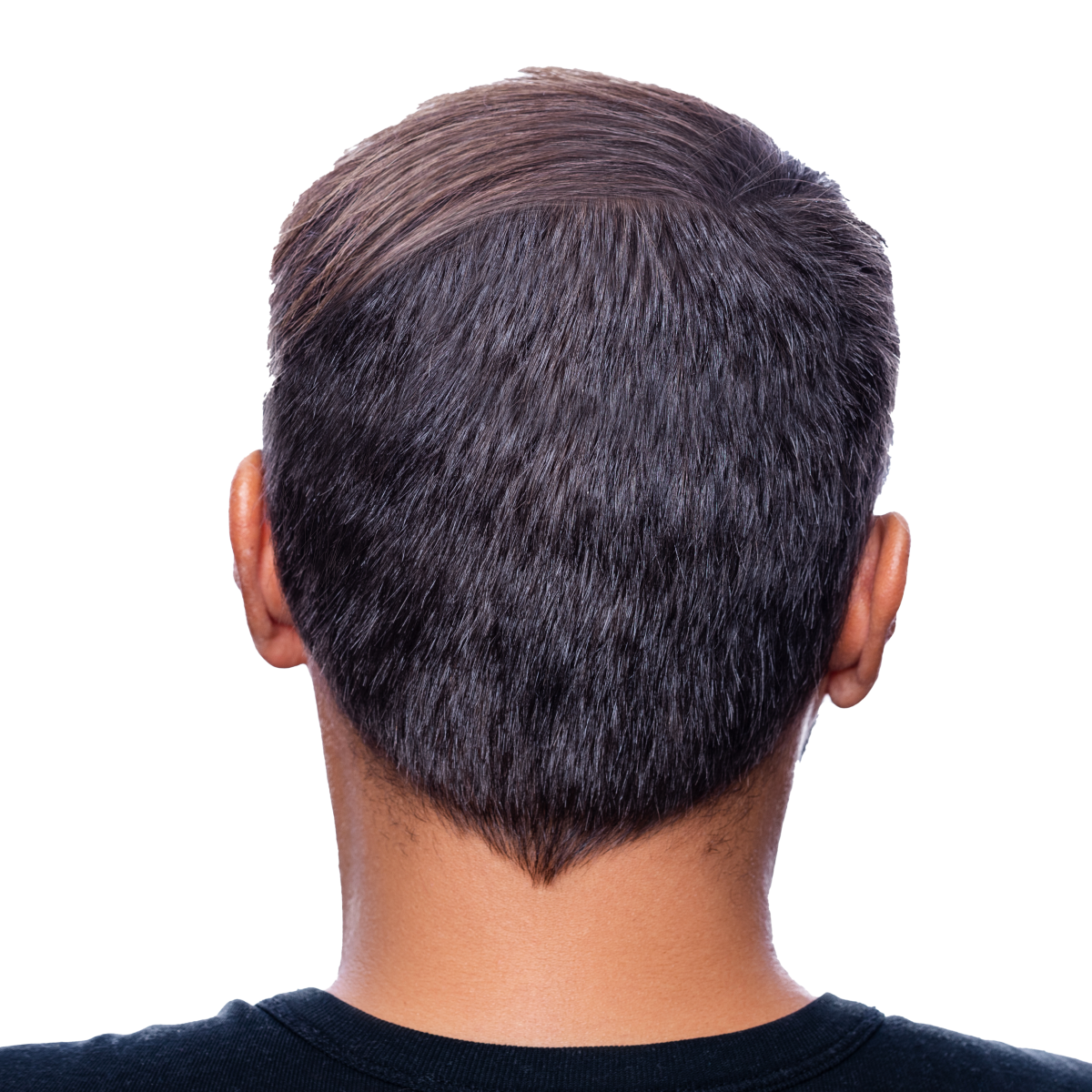 greffe_cheveux